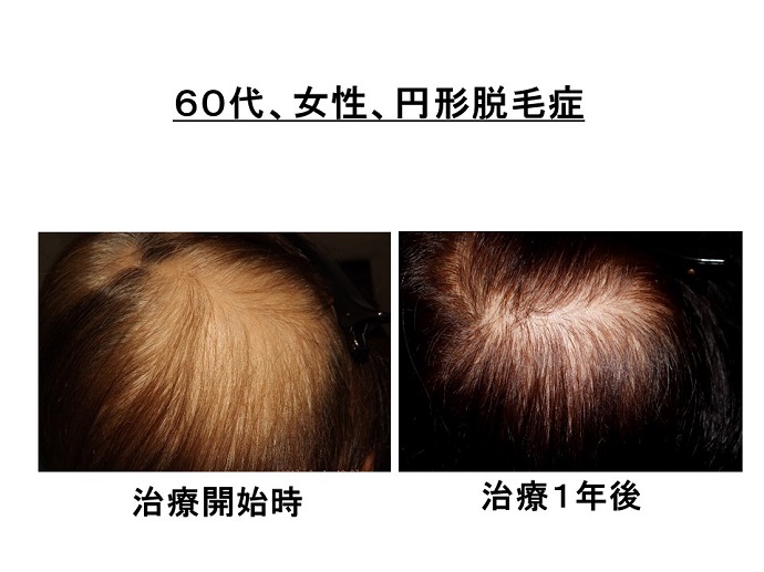 円形脱毛症　病院